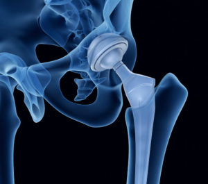 Exactech hip replacement recall