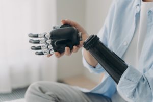 injured woman with artificial hand