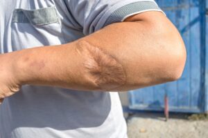 A man bears a scar on his arm, a testament to a vicious dog's bite.