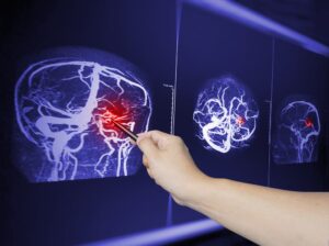 Close up Hand doctor point MRA brian scan image of a recent traumatic brain injury